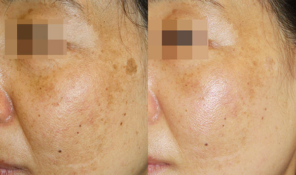 Pico Genesis Before and After Photo by Dr. Wang in Los Angeles, CA