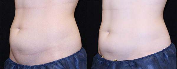 Trusculpt Before and After Photo by Dr. Wang in Los Angeles, CA