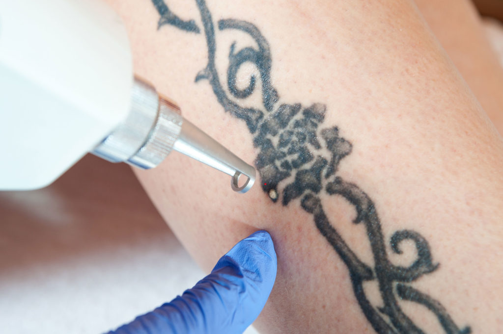 Tattoo Removal Metropolis Dermatology Los Angeles