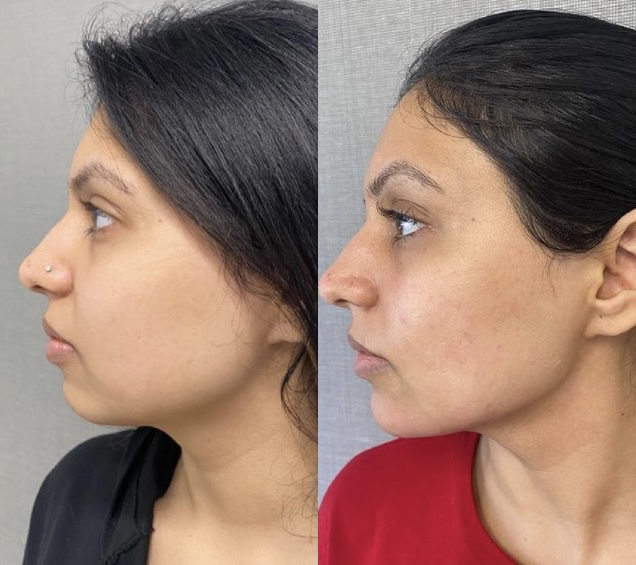 Facial Contouring Before and After Photo by Dr. James Y. Wang of Metropolis Dermatology in Los Angeles, CA