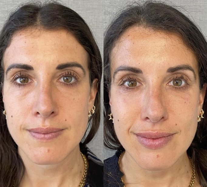 Lip, Under eye, and Cheek Filler Before and After Photo by Dr. James Y. Wang of Metropolis Dermatology in Los Angeles, CA
