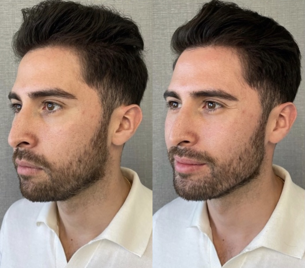 Male Facial Contouring Before and After Photo by Dr. James Y. Wang of Metropolis Dermatology in Los Angeles, CA