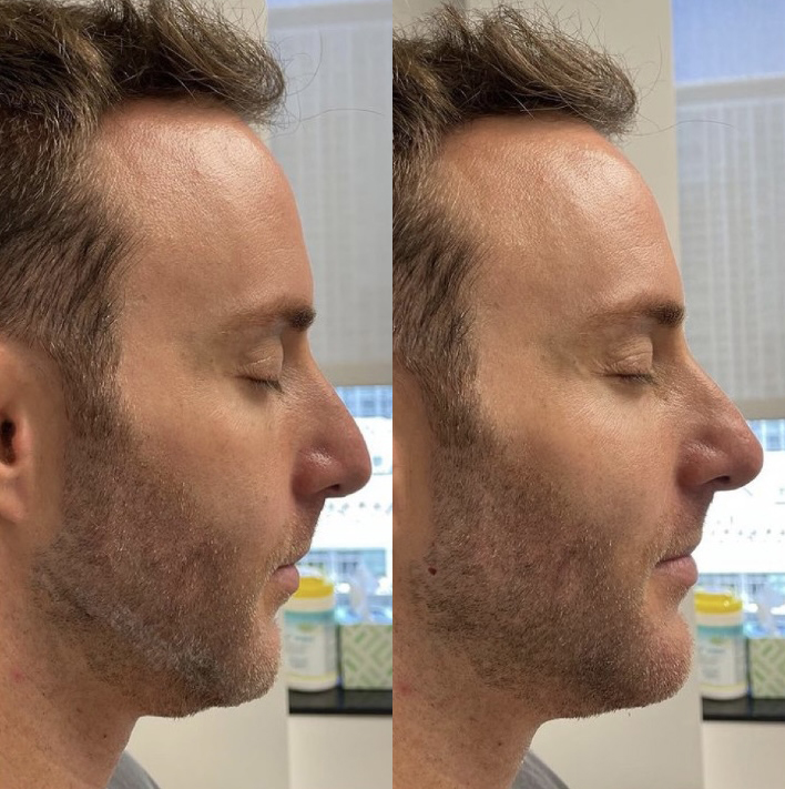Male Facial Contouring Before and After Photo by Dr. James Y. Wang of Metropolis Dermatology in Los Angeles, CA