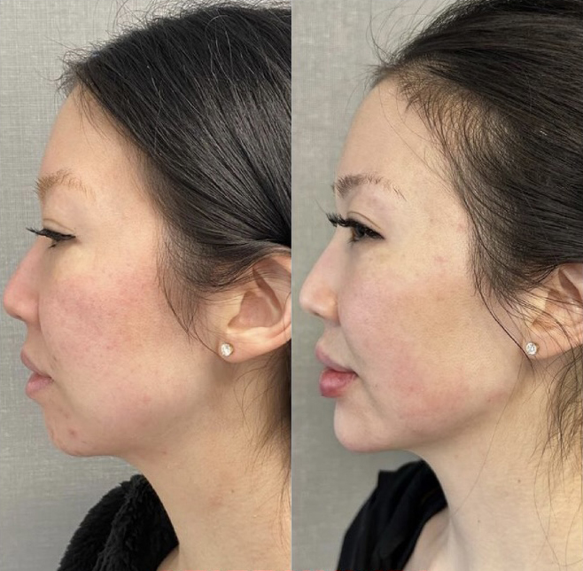 Female Facial Contouring Before and After Photo by Dr. James Y. Wang of Metropolis Dermatology in Los Angeles, CA