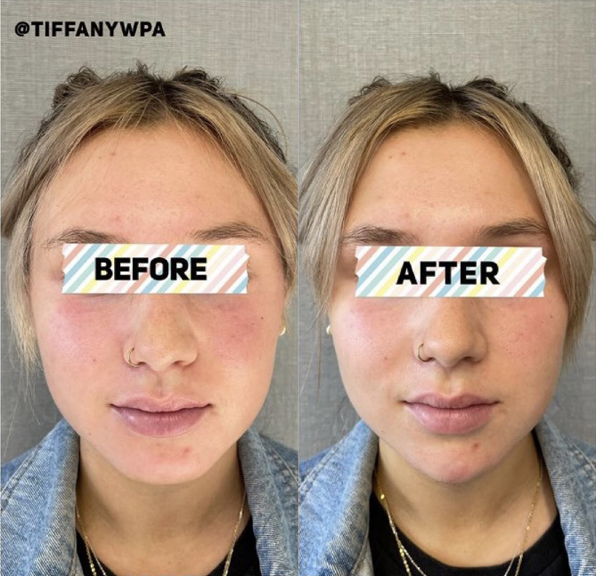 Female Facial Contouring Before and After Photo by Dr. James Y. Wang of Metropolis Dermatology in Los Angeles, CA