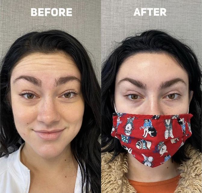 Forehead Botox Before and After Photo by Dr. James Y. Wang of Metropolis Dermatology in Los Angeles, CA
