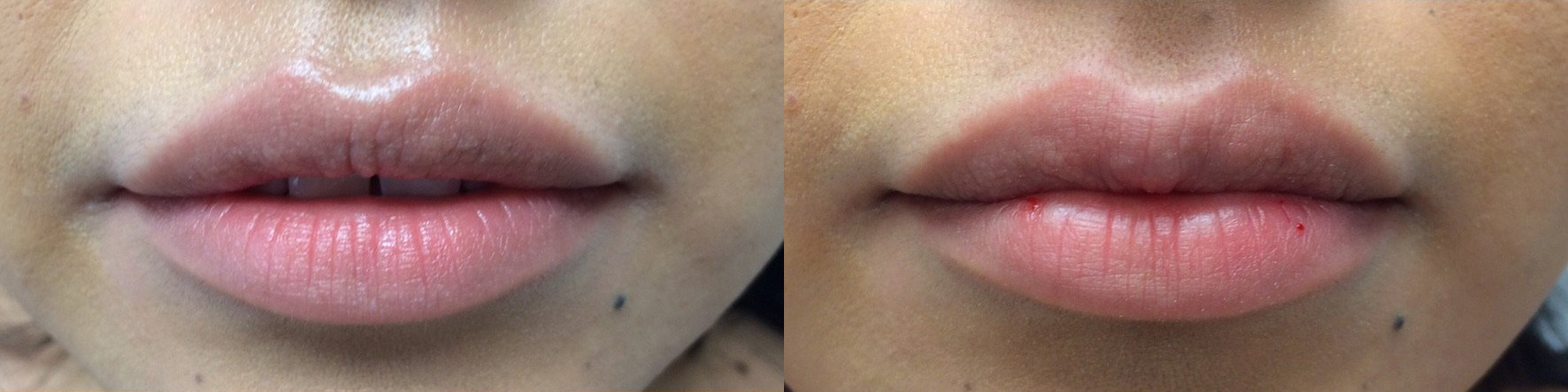 Lip Filler Before and After Photo by Dr. James Y. Wang of Metropolis Dermatology in Los Angeles, CA