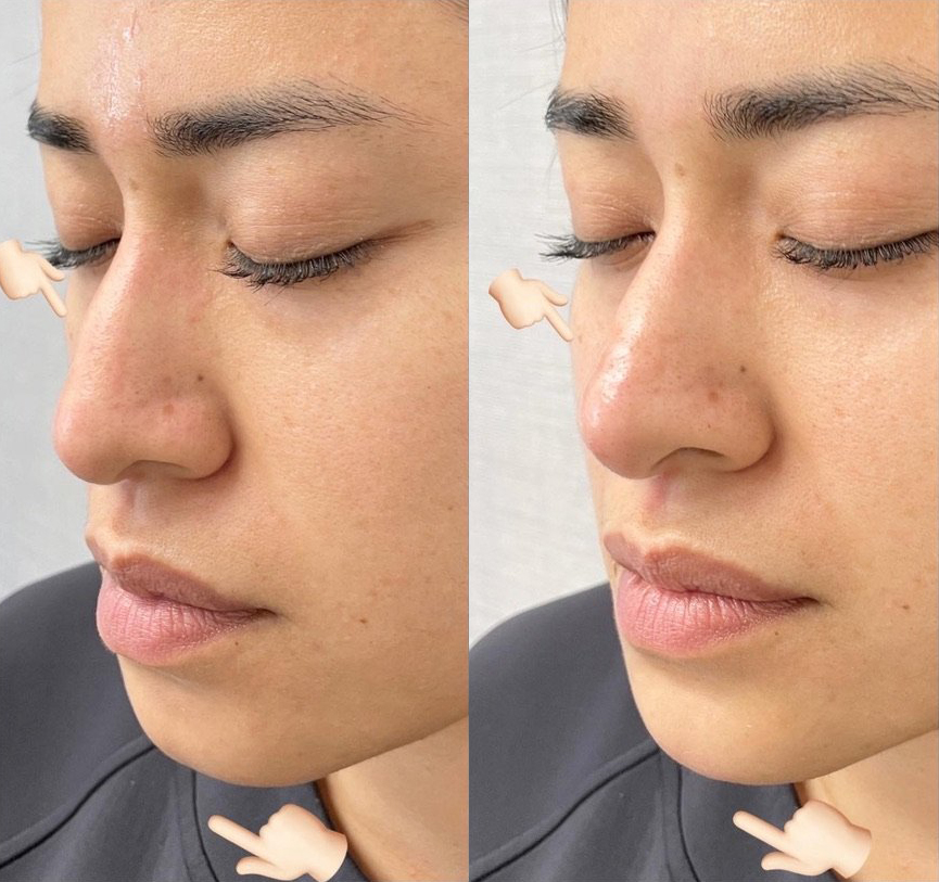 Liquid Rhinoplasty Before and After Photo by Dr. James Y. Wang of Metropolis Dermatology in Los Angeles, CA