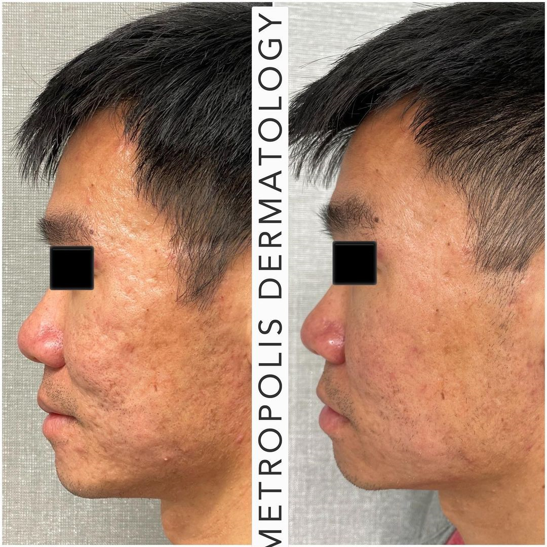 Laser Acne Scarring Treatment Before and After Photo by Dr. James Y. Wang of Metropolis Dermatology in Los Angeles, CA