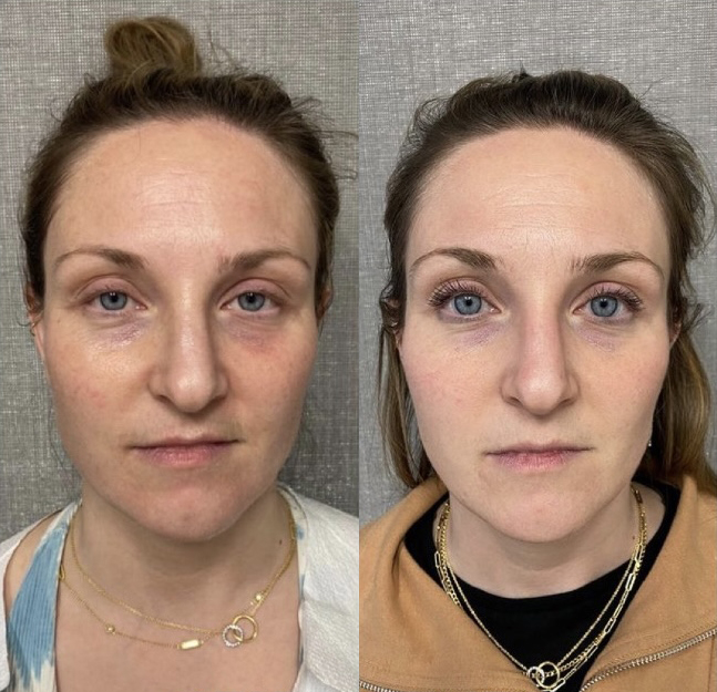 RF Microneedling Before and After Photo by Dr. James Y. Wang of Metropolis Dermatology in Los Angeles, CA