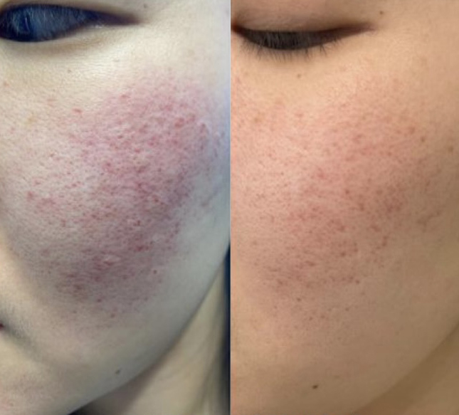 Rosacea Treatment Before and After Photo by Dr. James Y. Wang of Metropolis Dermatology in Los Angeles, CA