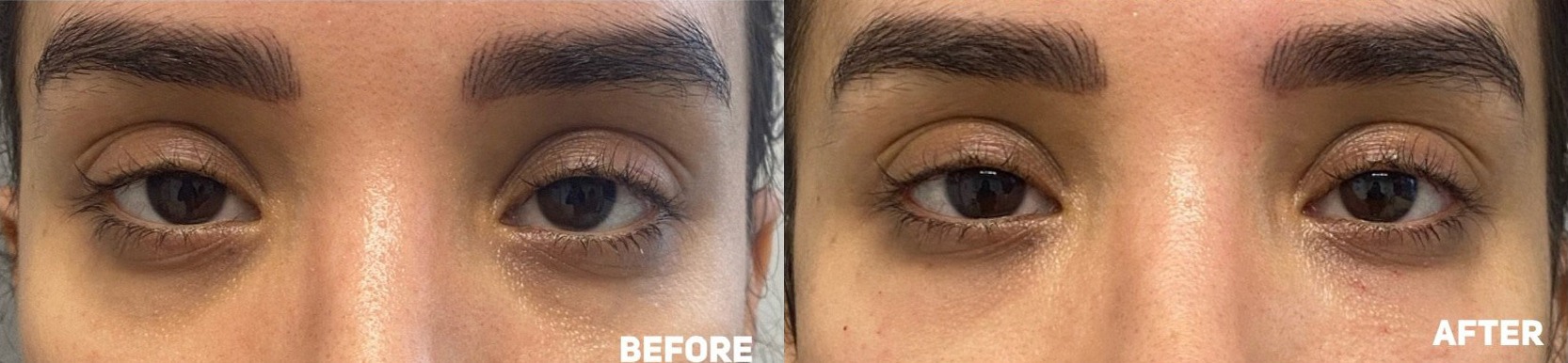 Under Eye PRP Before and After Photo by Dr. James Y. Wang of Metropolis Dermatology in Los Angeles, CA