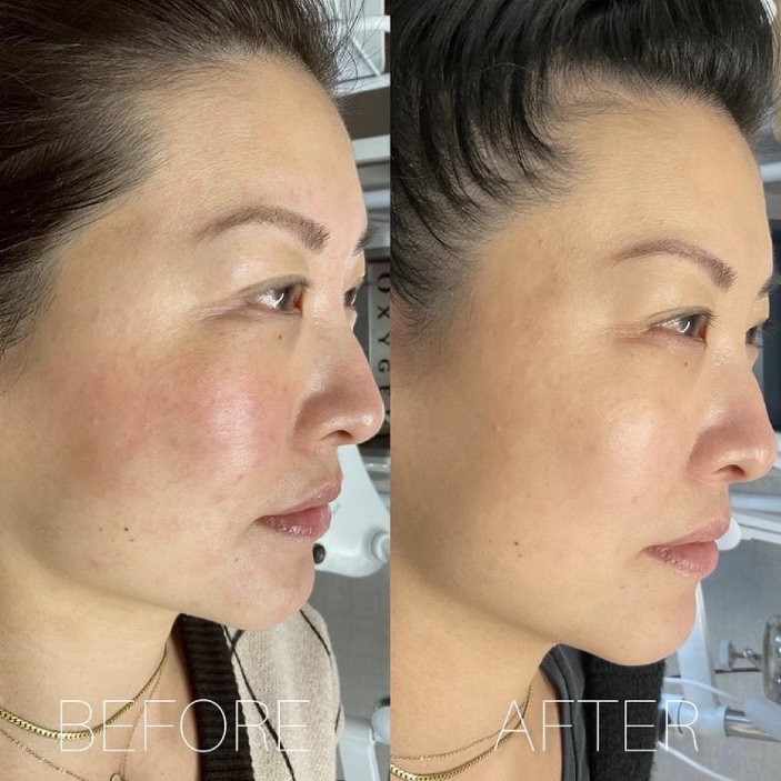 Chemical Peel Before and After Photo by Dr. James Y. Wang of Metropolis Dermatology in Los Angeles, CA