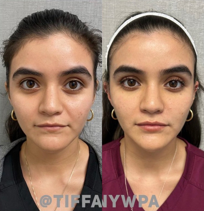 Sculptra Before and After Photo by Dr. James Y. Wang of Metropolis Dermatology in Los Angeles, CA