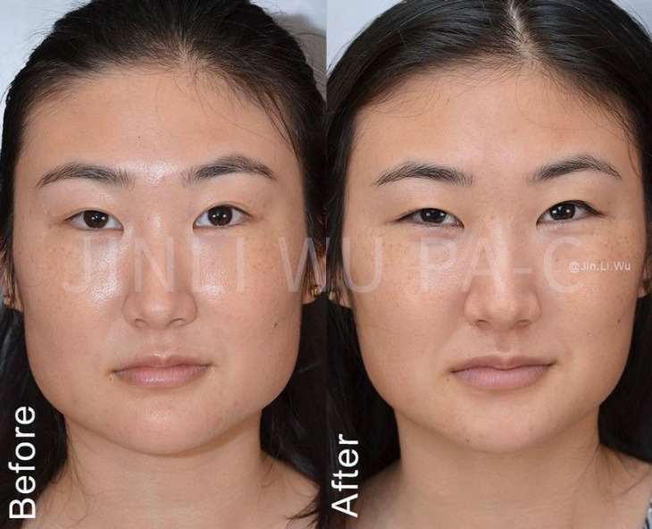 Masseter Reduction with Dysport Before and After Photo by Dr. James Y. Wang of Metropolis Dermatology in Los Angeles, CA