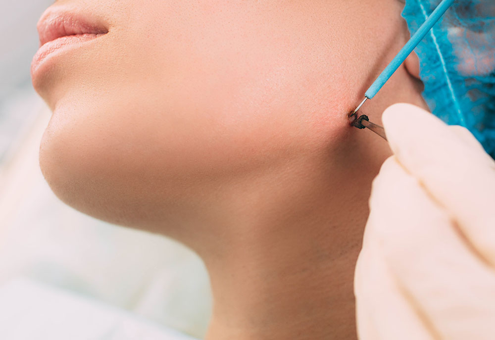Patient getting mole removing with electrocautery