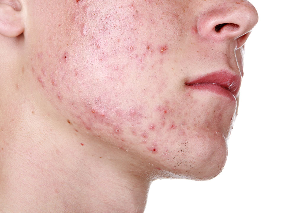 acne on the face of a young man