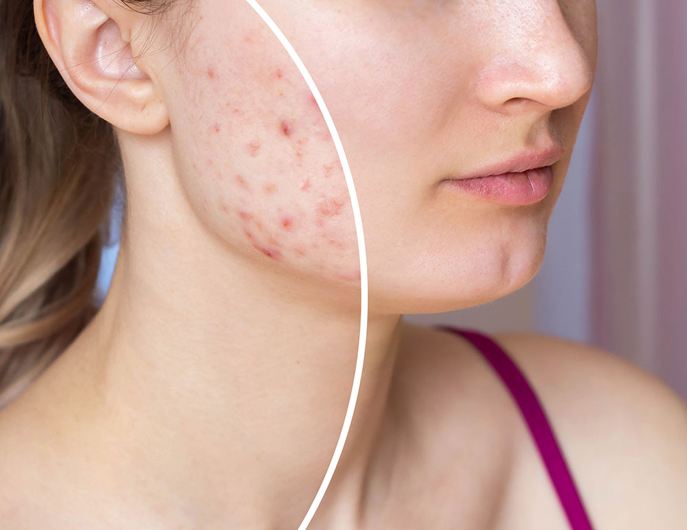 young woman's face before and after acne treatment