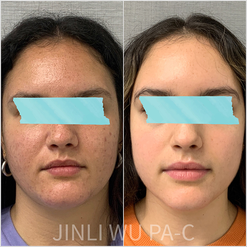 Acne Treatment Before and After Photo by Dr. James Y. Wang of Metropolis Dermatology in Los Angeles, CA