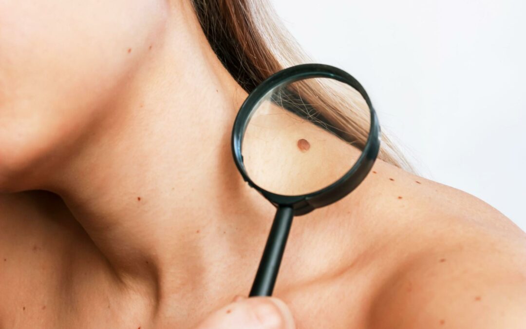 How Dermatology Can Help You Understand and Treat Moles