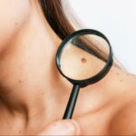How Dermatology Can Help You Understand and Treat Moles