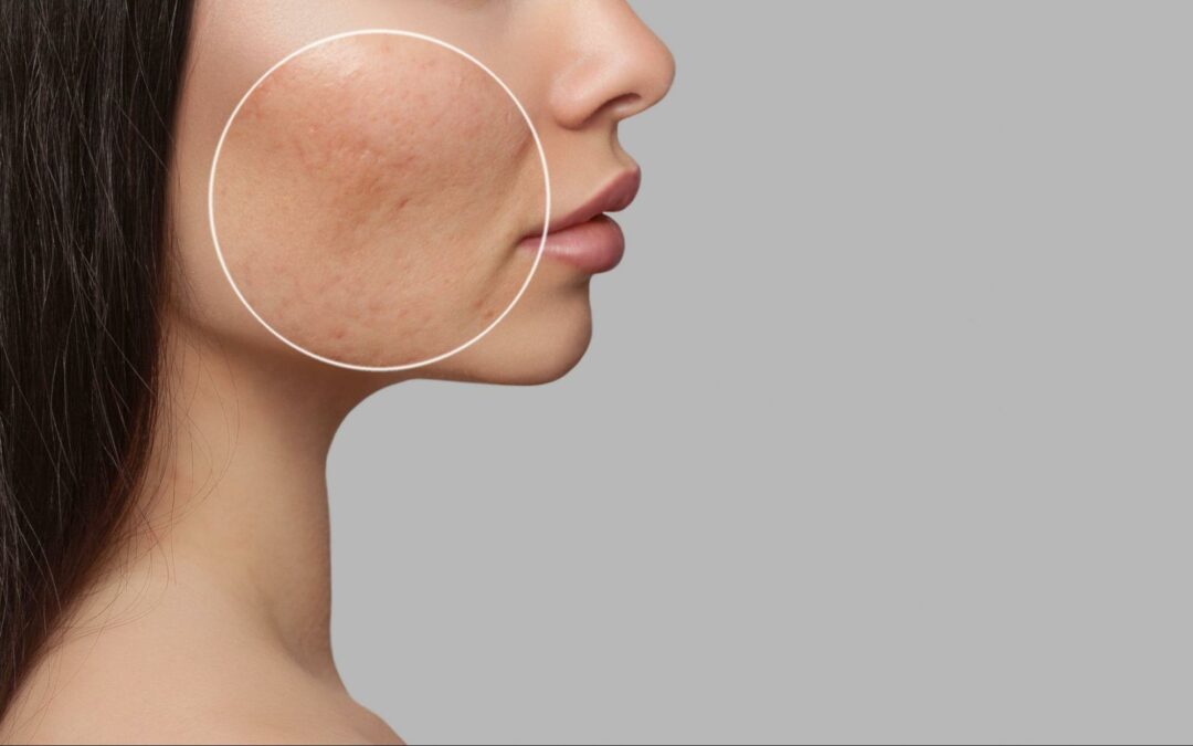 Who’s a Good Candidate For Acne Scarring Treatment