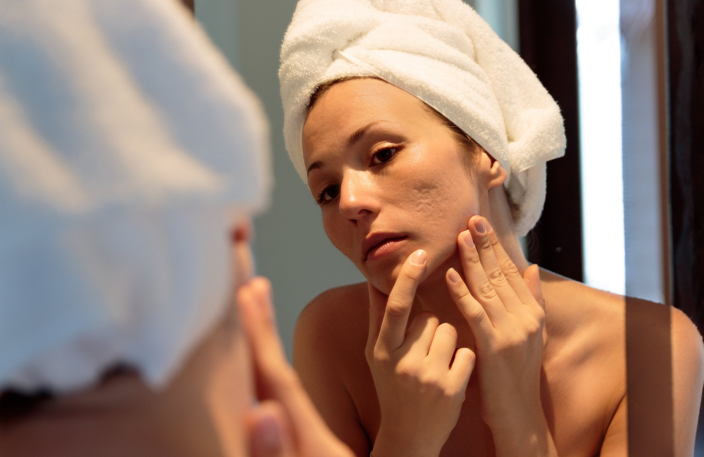 Acne Scarring Metropolis Dermatology Los Angeles