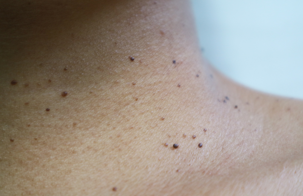 Acne Scarring Metropolis Dermatology Los Angeles