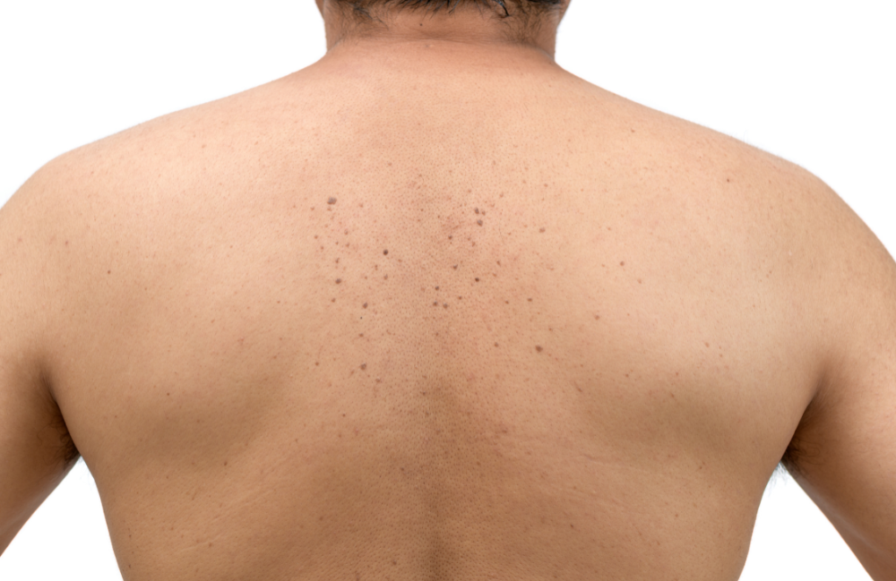 Acne Scarring Metropolis Dermatology Los Angeles