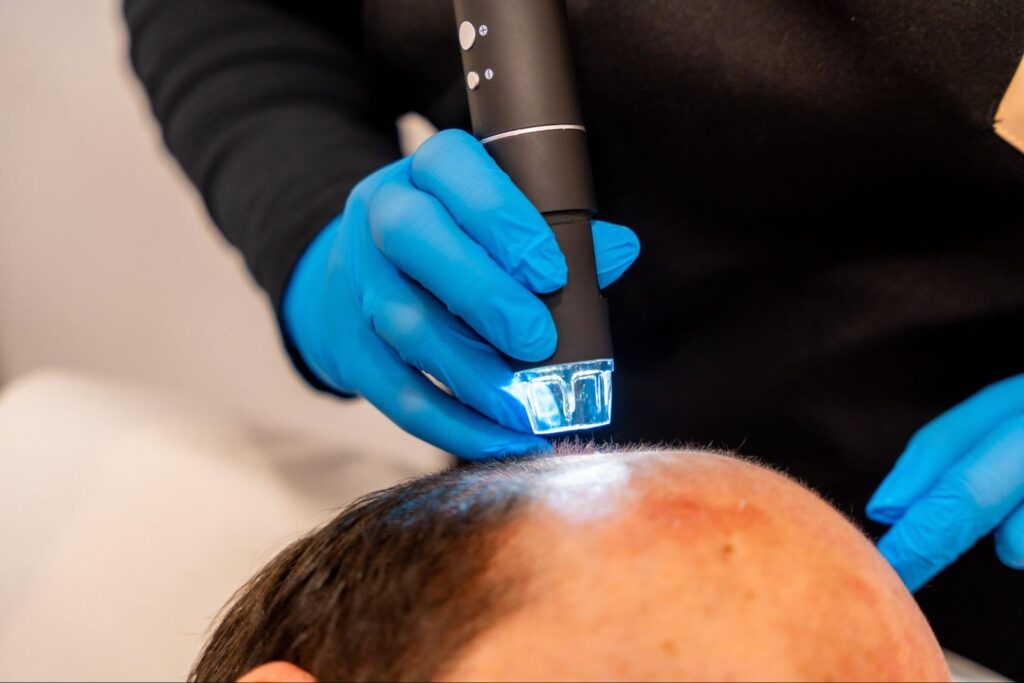 Laser hair restoration treatment being performed on a patient’s scalp for follicle stimulation and hair regrowth.