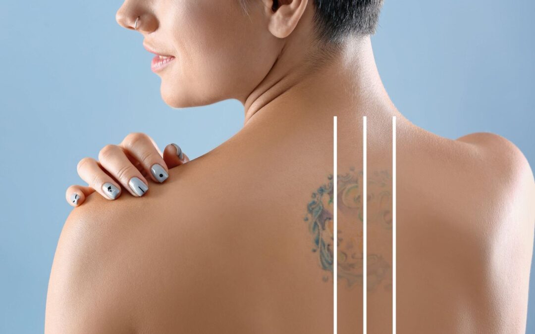 Understanding Scarring After Tattoo Removal: What to Know