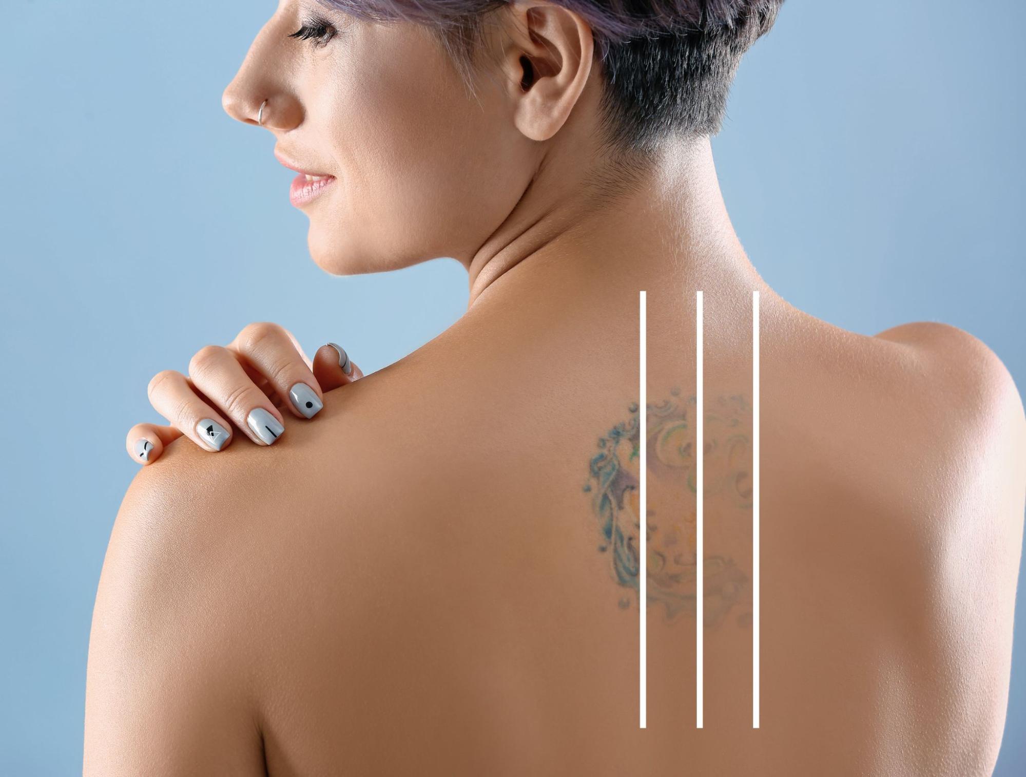 Tattoo Removal