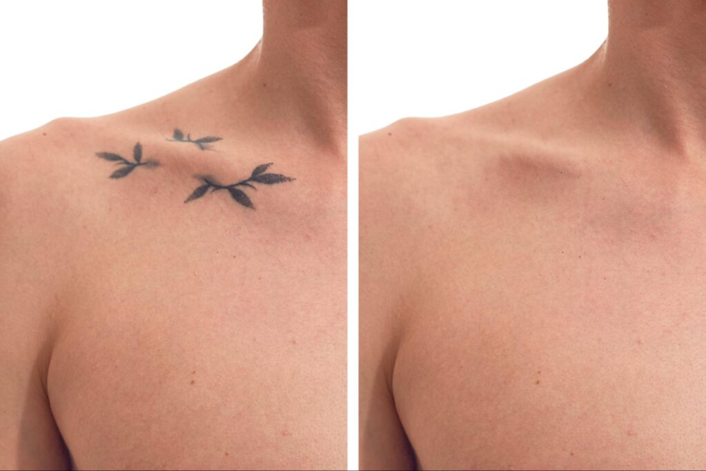 Clear skin after successful tattoo removal, with no visible ink or scarring.