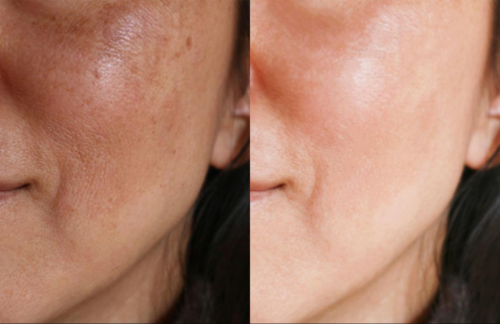 Acne Scarring Metropolis Dermatology Los Angeles