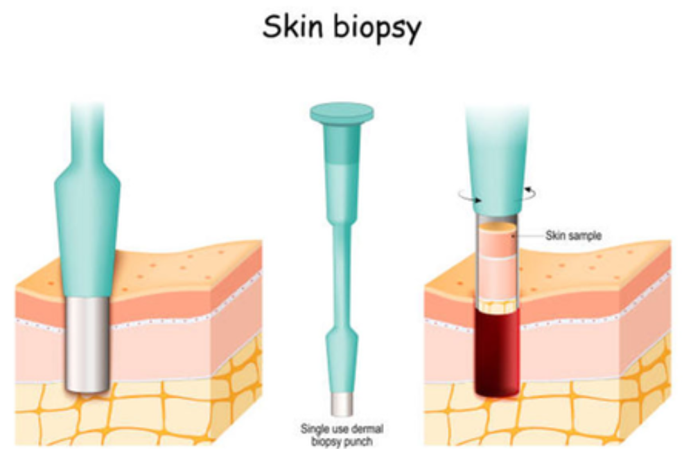 Skin Biopsy | Metropolis Dermatology