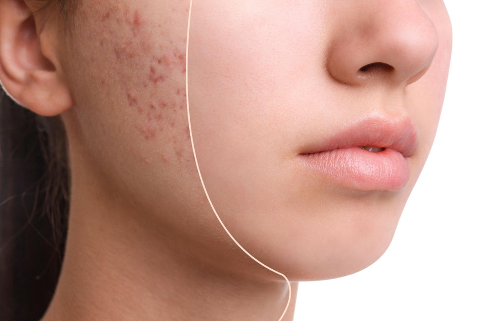 Acne Scarring Metropolis Dermatology Los Angeles