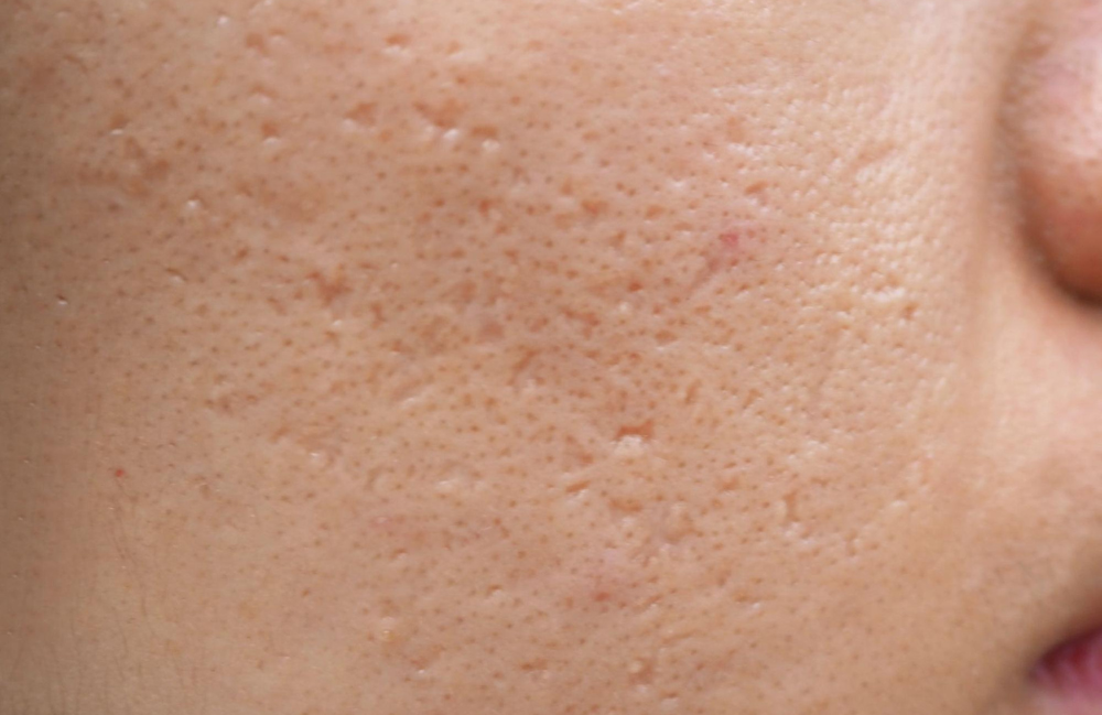 Acne Scarring Metropolis Dermatology Los Angeles