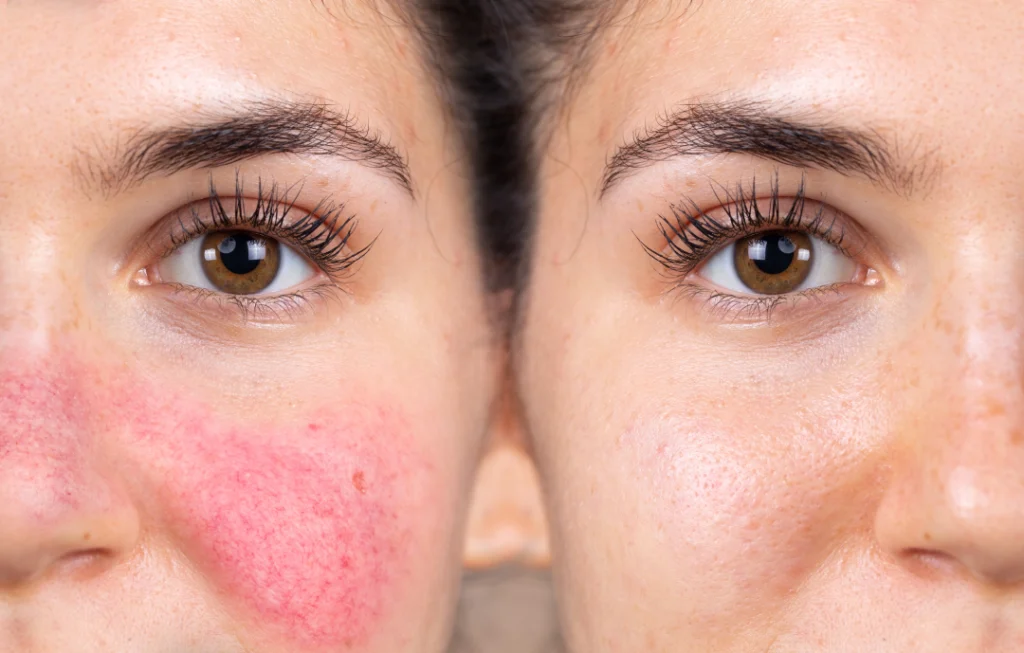  Before and after results of a rosacea laser treatment showing reduced redness.