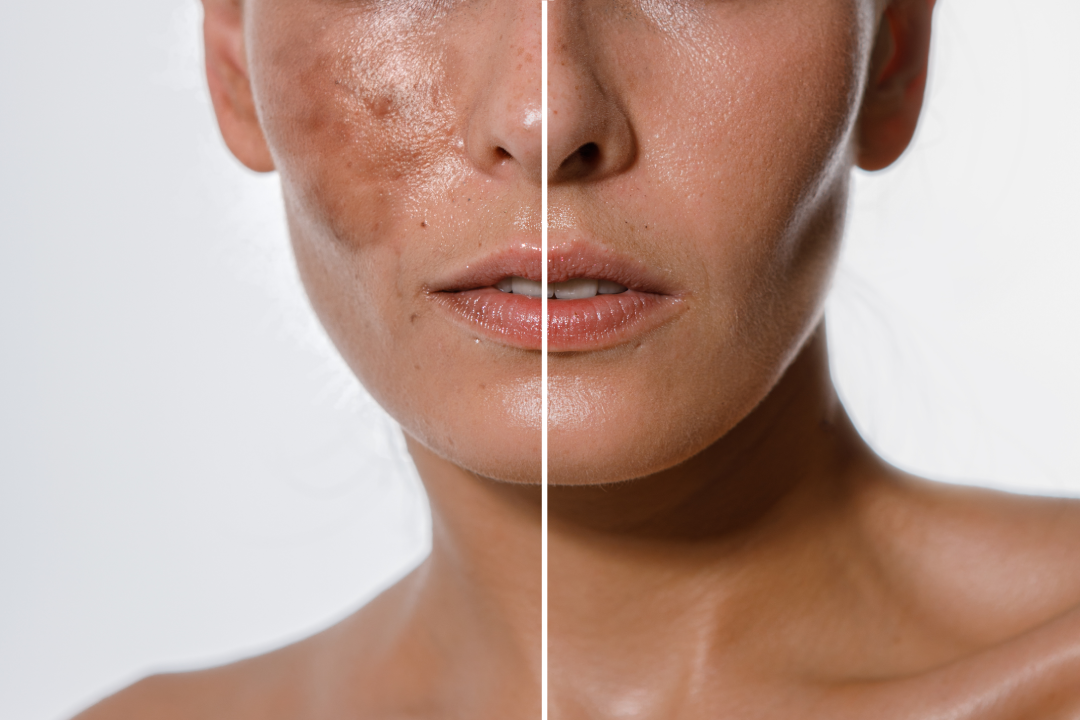 Before and after results of sunspot removal showcasing clearer skin.