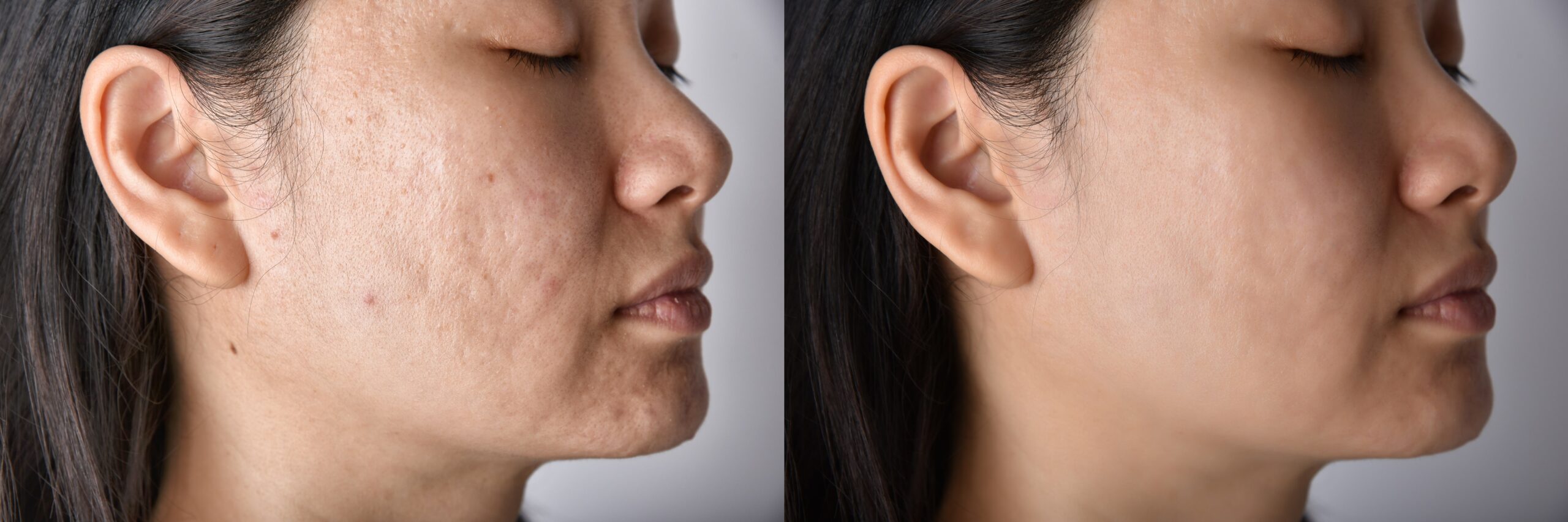 Laser scar treatment before and after comparison showcasing smooth skin results.