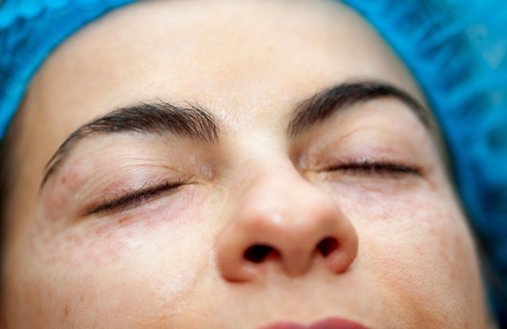 Acne Scarring Metropolis Dermatology Los Angeles