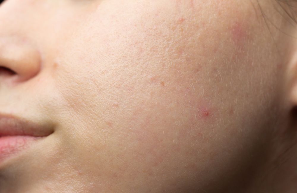 Acne Scarring Metropolis Dermatology Los Angeles