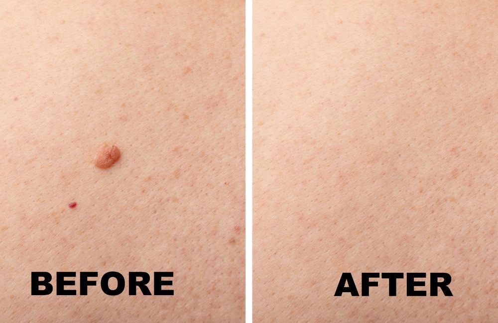 Acne Scarring Metropolis Dermatology Los Angeles