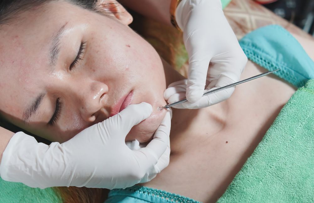 Acne Scarring Metropolis Dermatology Los Angeles