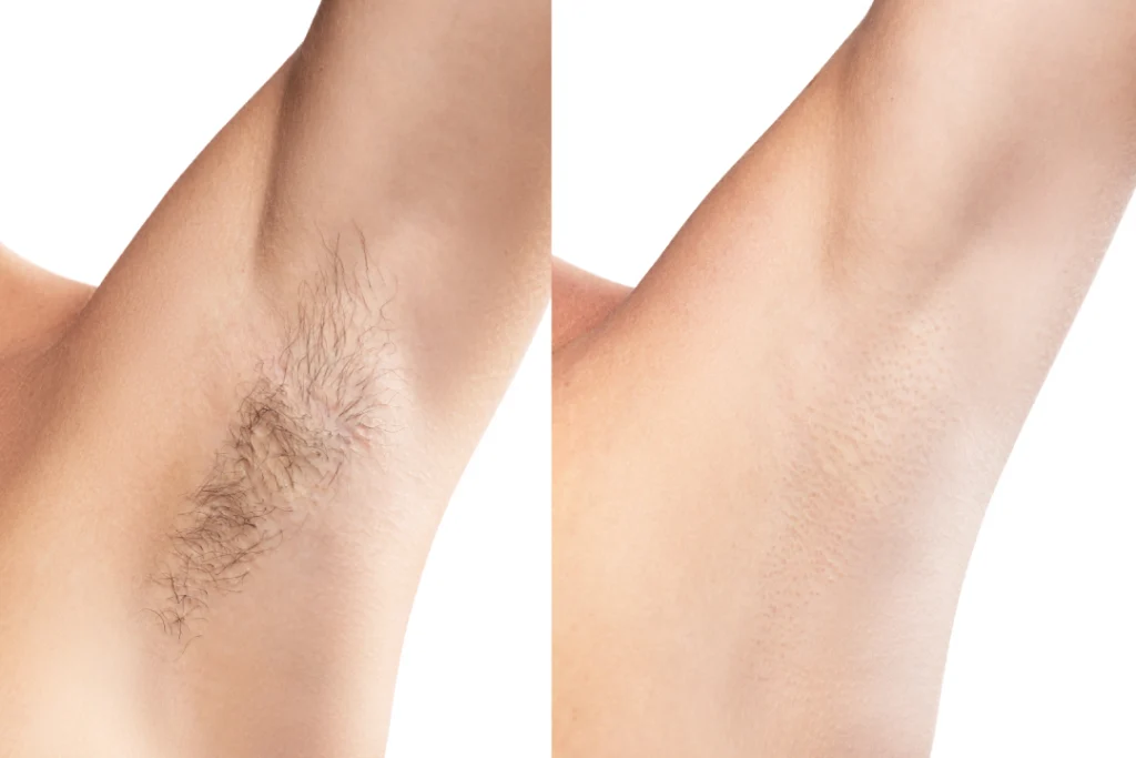 Before and after laser hair removal showing smooth underarm transformation