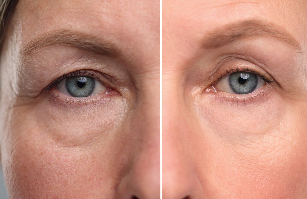 PRP-undereye-before-after Side-by-side comparison of a woman's neck before and after platysmal band injections.