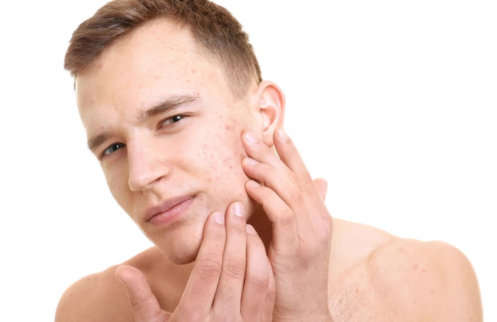 acne-and-scarring-skin-check Acne Scarring Metropolis Dermatology Los Angeles