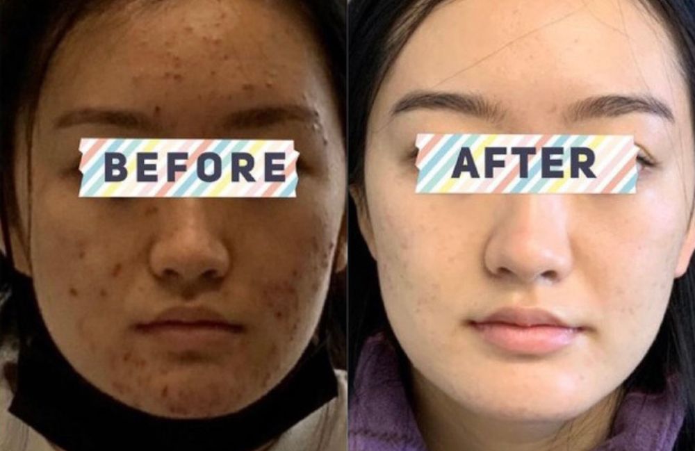 acne-and-scarring-treatment-result Acne Scarring Metropolis Dermatology Los Angeles