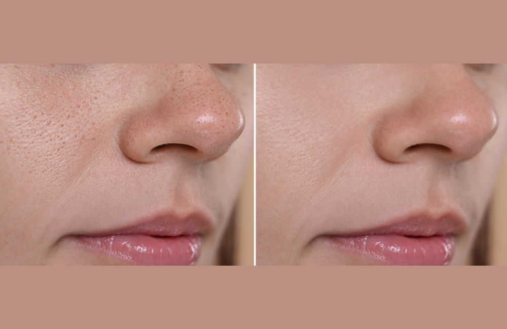 blackhead-extraction-before-after Side-by-side comparison of a woman's neck before and after platysmal band injections.