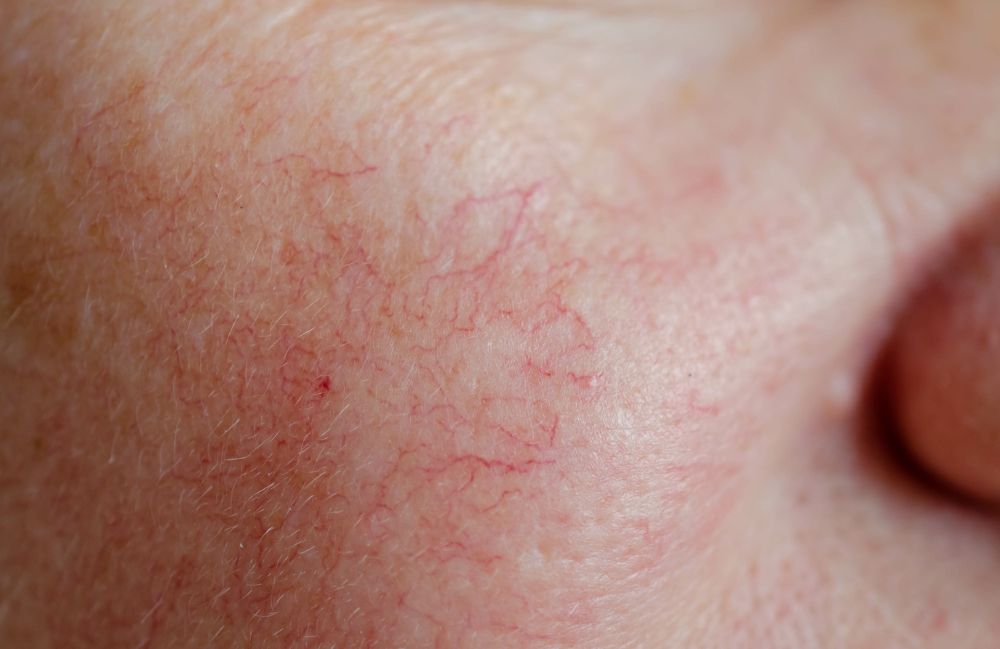 broken-blood-vessels-skin-closeup Close-up of a woman's neck showing visible platysmal bands before treatment.